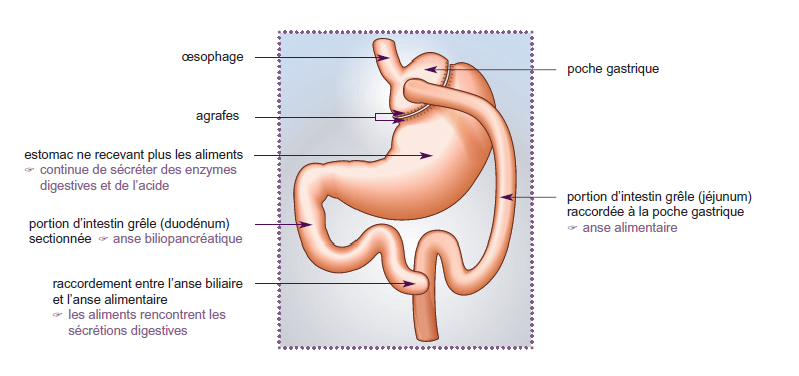 By-pass gastrique schéma 1