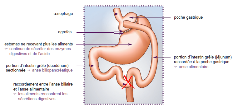 Schéma 2 by pass gastrique