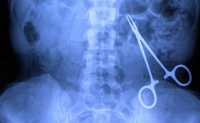 Radio de l'abdomen montrant un corp étranger - La Prévention Médicale