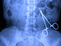 Radio de l'abdomen montrant un corp étranger - La Prévention Médicale