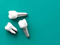 Implant dentaire