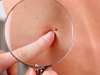 Examen dermatologie, bouton dans le dos
