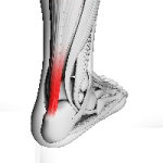 rupture tendon d'Achille, opération, pied